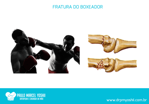 fratura-do-boxeador fratura-do-boxeador